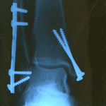 X-ray of broken foot X-ray of a broken foot after ski accident